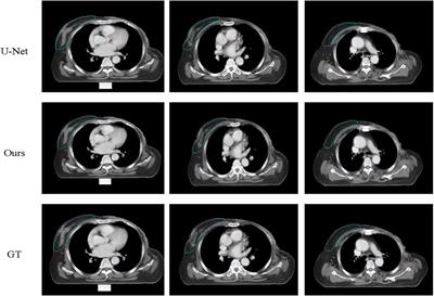 Deep Learning-Aided Automatic Contouring of Clinical Target Volumes for Radiotherapy in Breast Cancer After Modified Radical Mastectomy